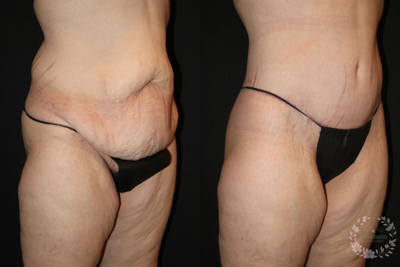 Before and after lower body lift surgery by Dr. Emily Hartmann showing circumferential body contouring after massive weight loss. - Angle 2