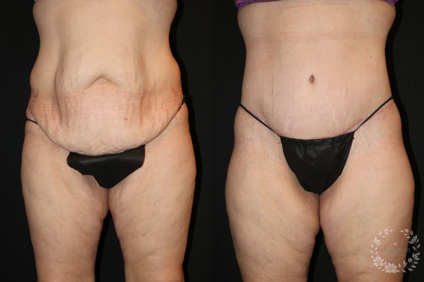 Before and after lower body lift surgery by Dr. Emily Hartmann showing circumferential body contouring after massive weight loss.