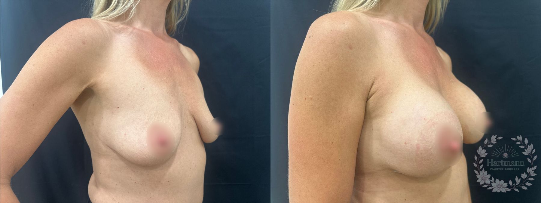 Before and after Motiva Preservé breast augmentation by Dr. Emily Hartmann. - Angle 5