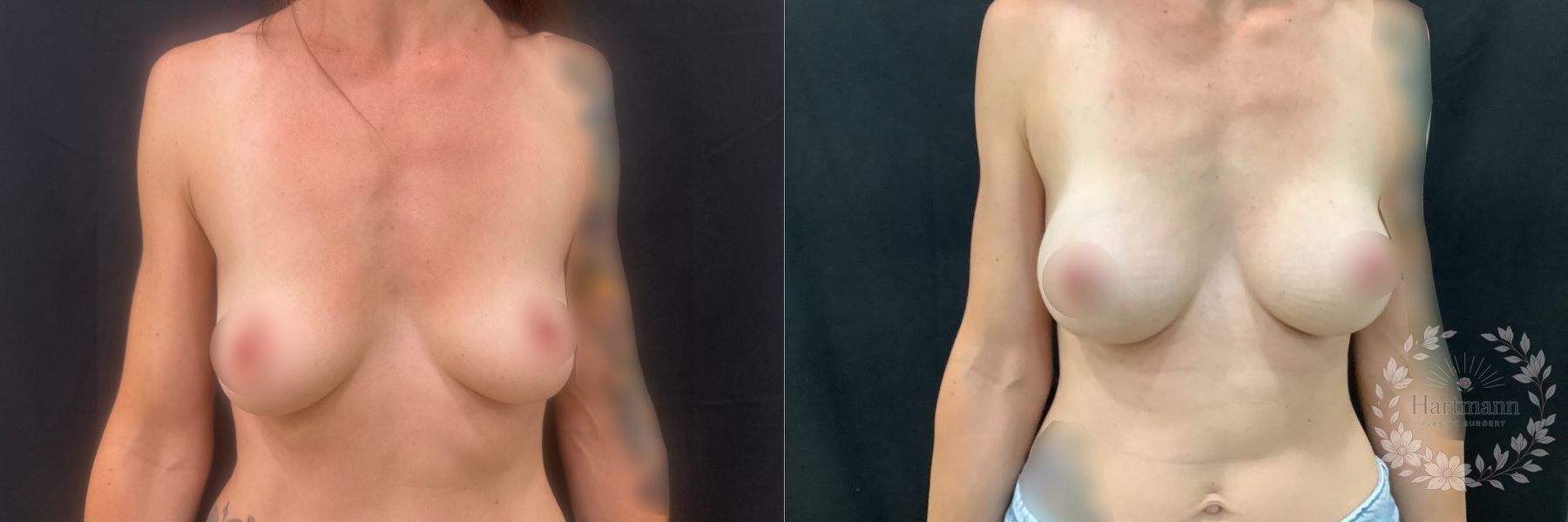 3-month before and after results following Motiva Preservé breast augmentation by Dr. Emily Hartmann in Chico, California, showing natural-appearing breast volume and balanced proportions.