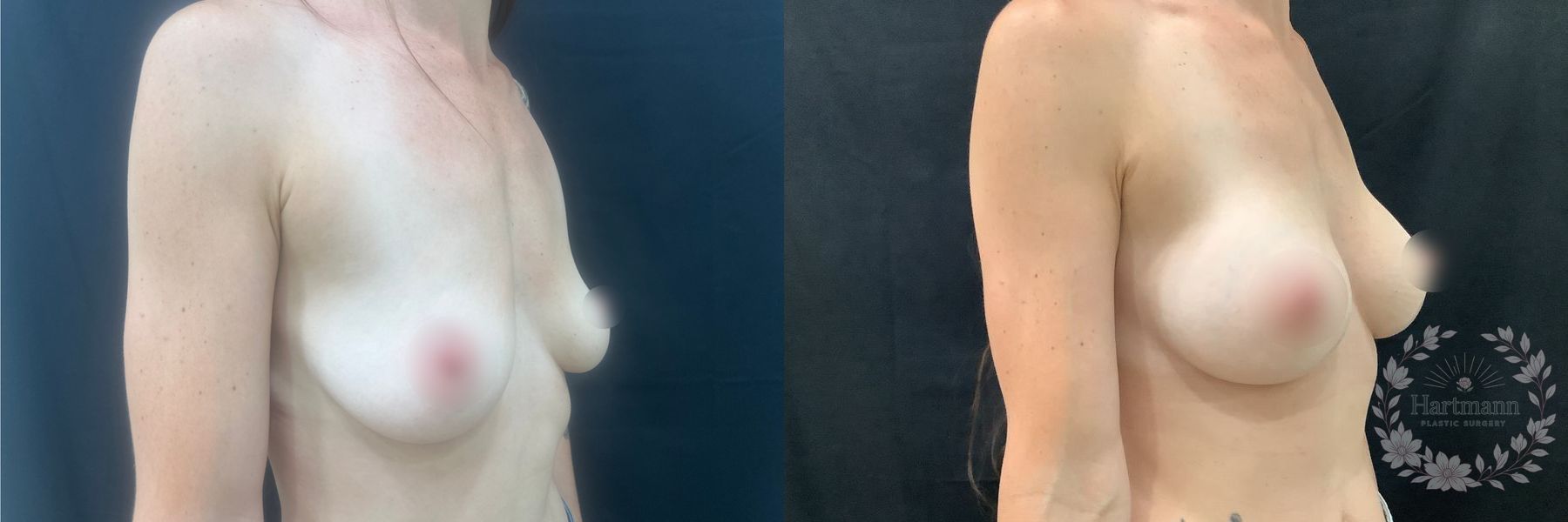 3-month before and after results following Motiva Preservé breast augmentation by Dr. Emily Hartmann in Chico, California, showing natural-appearing breast volume and balanced proportions. - Angle 2