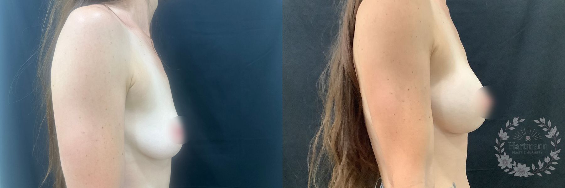 3-month before and after results following Motiva Preservé breast augmentation by Dr. Emily Hartmann in Chico, California, showing natural-appearing breast volume and balanced proportions. - Angle 5