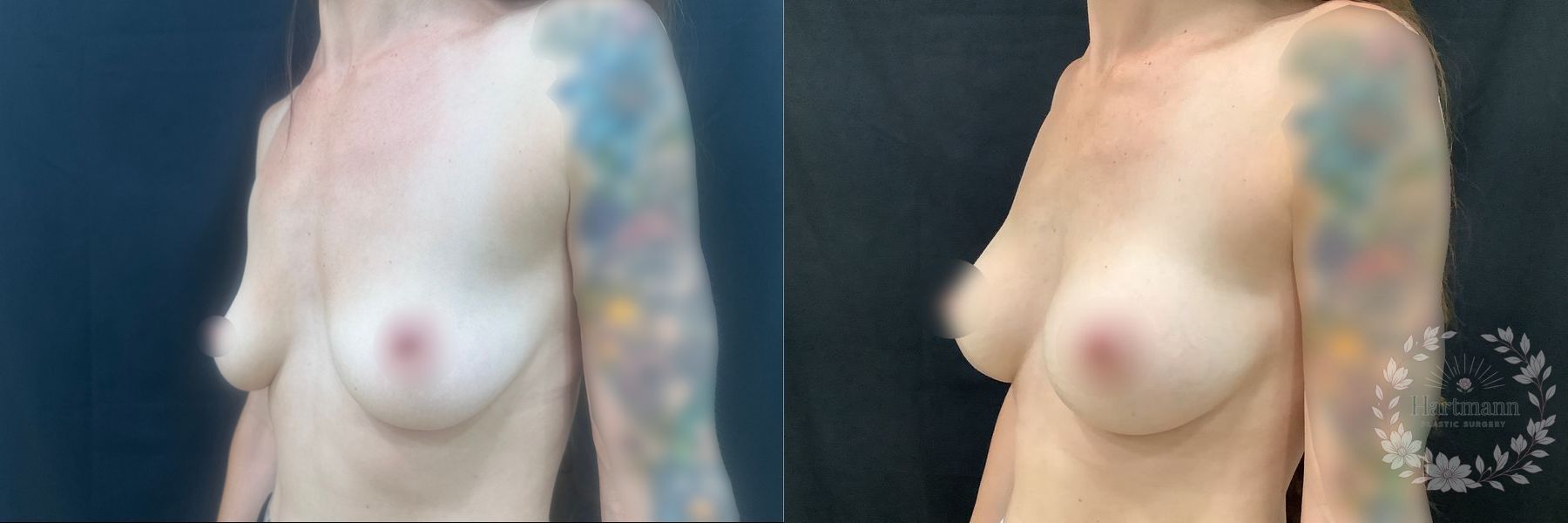 3-month before and after results following Motiva Preservé breast augmentation by Dr. Emily Hartmann in Chico, California, showing natural-appearing breast volume and balanced proportions. - Angle 3