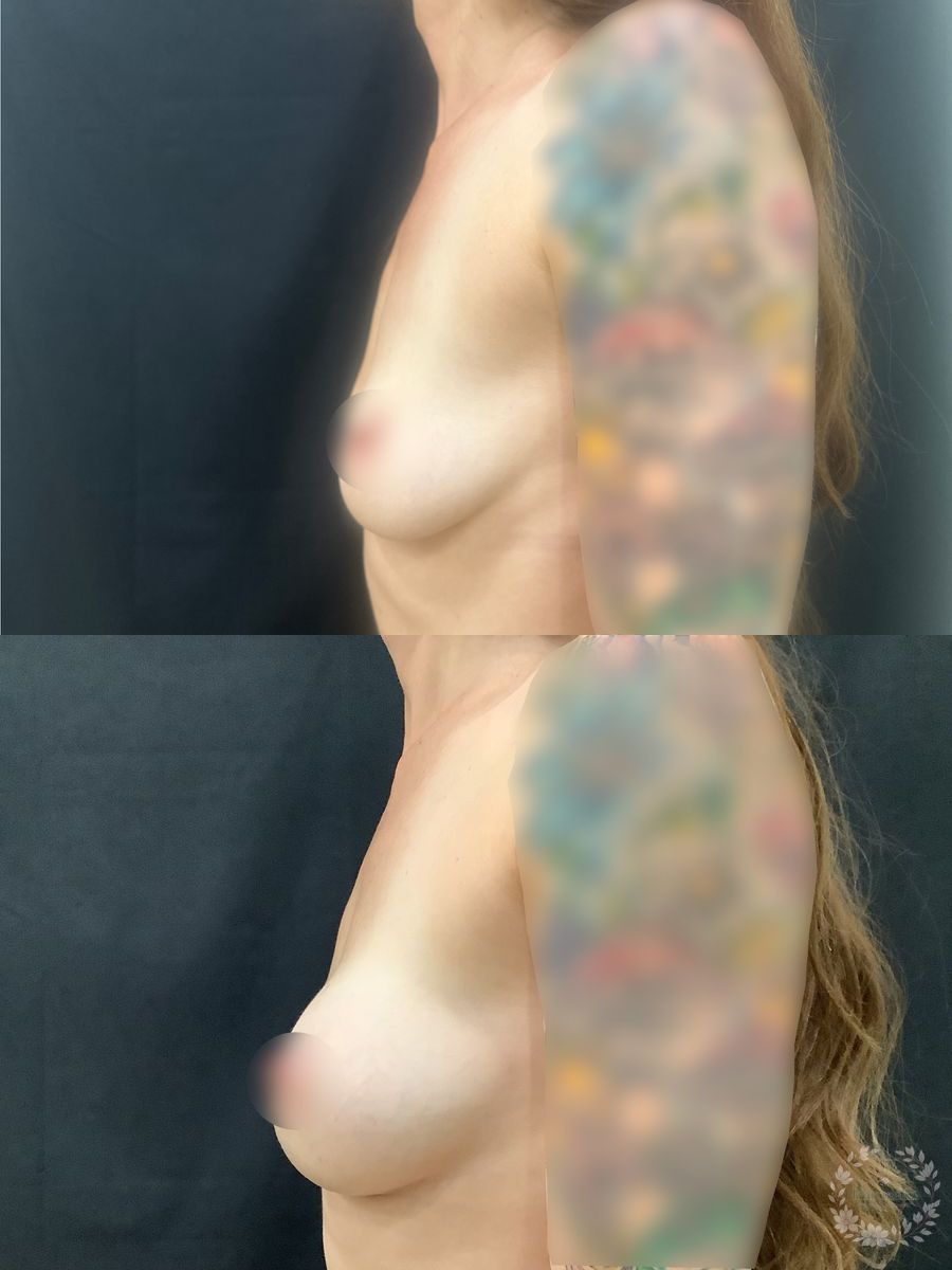 3-month before and after results following Motiva Preservé breast augmentation by Dr. Emily Hartmann in Chico, California, showing natural-appearing breast volume and balanced proportions. - Angle 4
