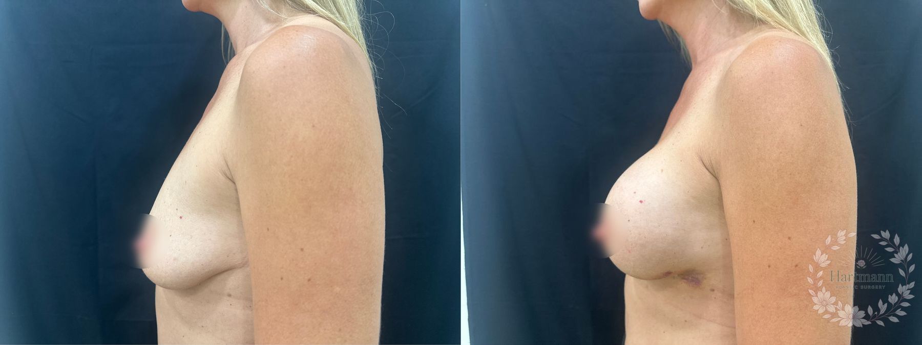 Before and after Motiva Preservé breast augmentation by Dr. Emily Hartmann. - Angle 3
