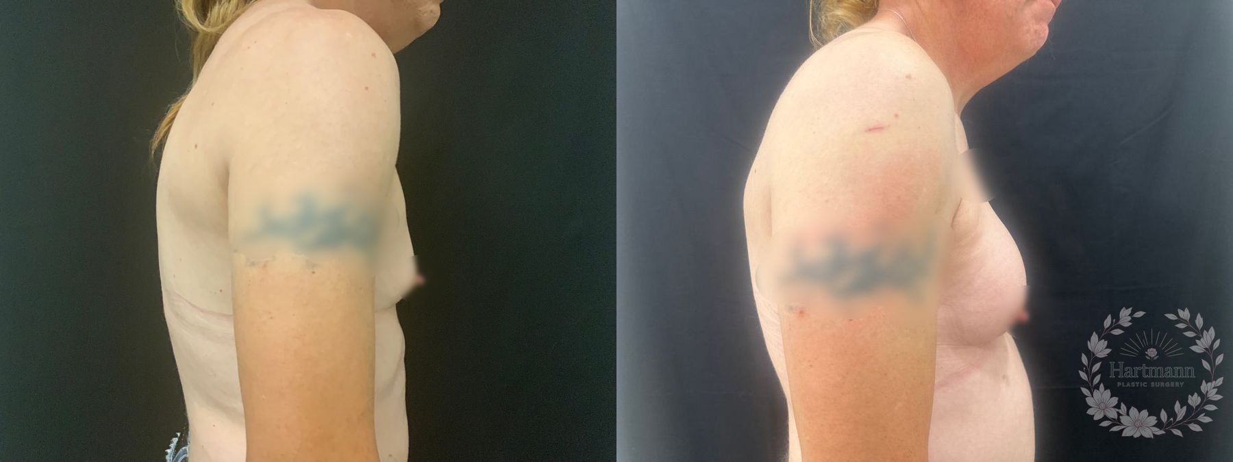 Before and after chest feminization surgery showing natural-appearing breast enhancement and feminine chest contour by Dr. Emily Hartmann. - Angle 3