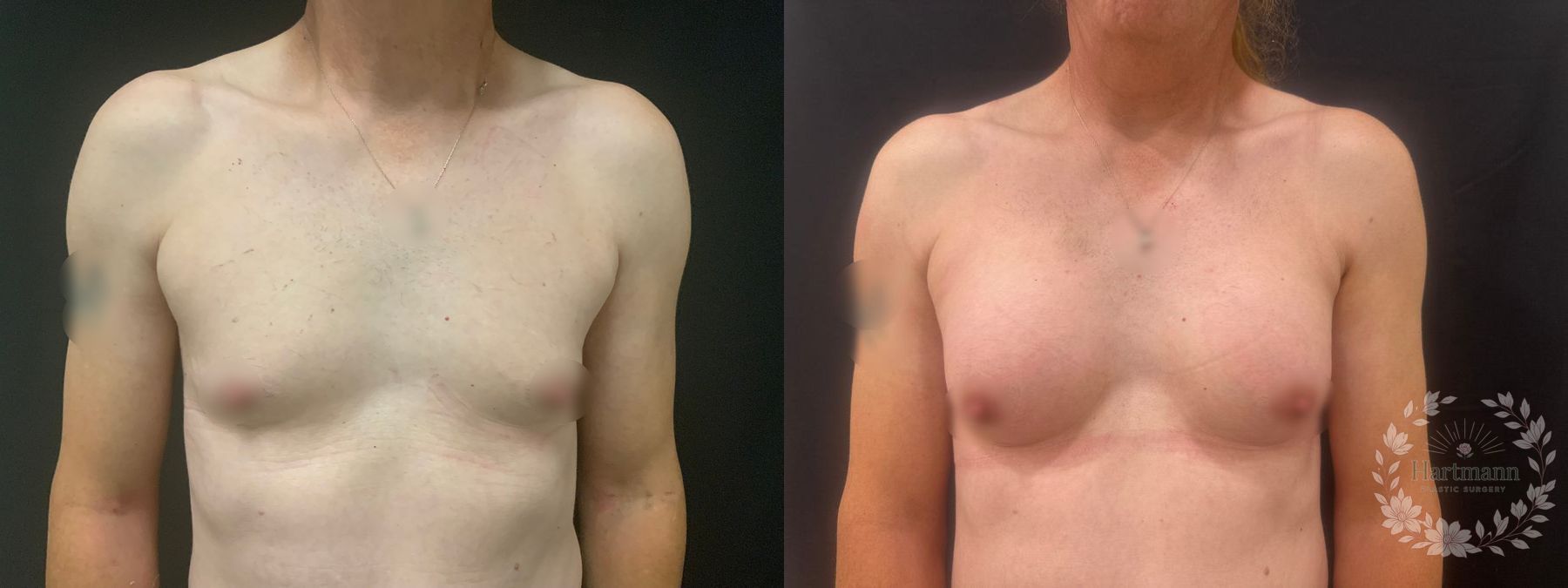 Before and after chest feminization surgery showing natural-appearing breast enhancement and feminine chest contour by Dr. Emily Hartmann.
