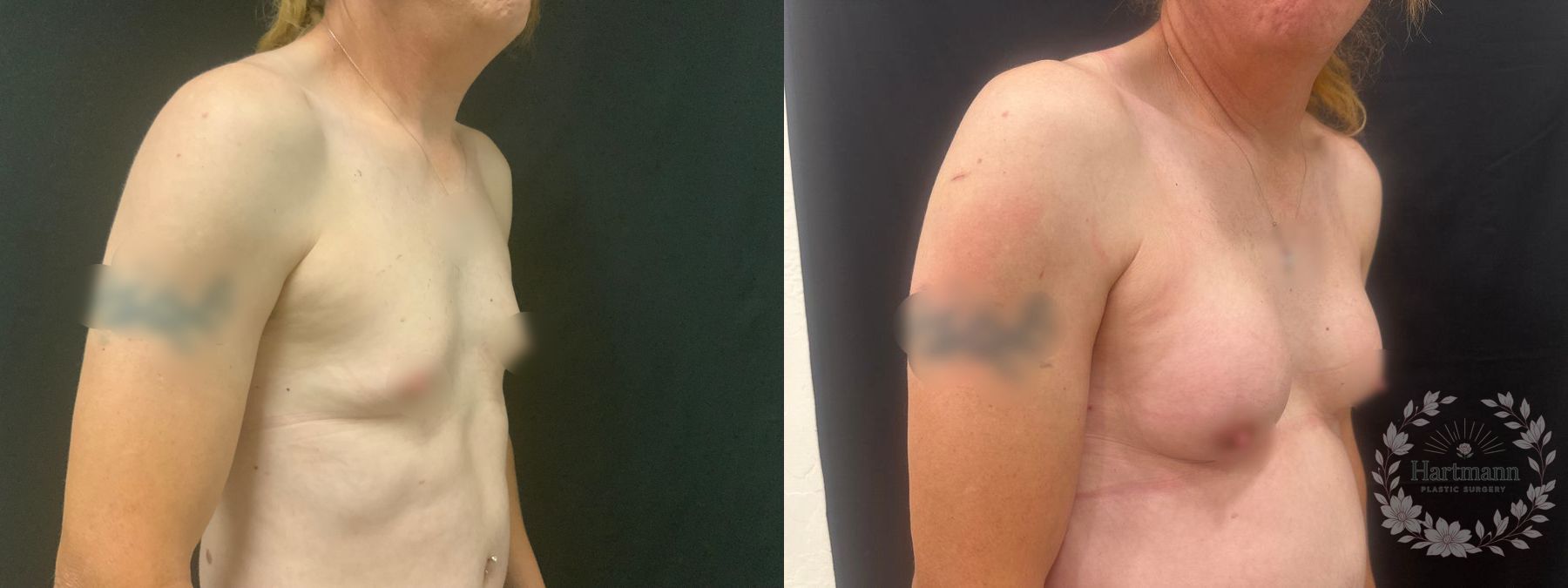 Before and after chest feminization surgery showing natural-appearing breast enhancement and feminine chest contour by Dr. Emily Hartmann. - Angle 2