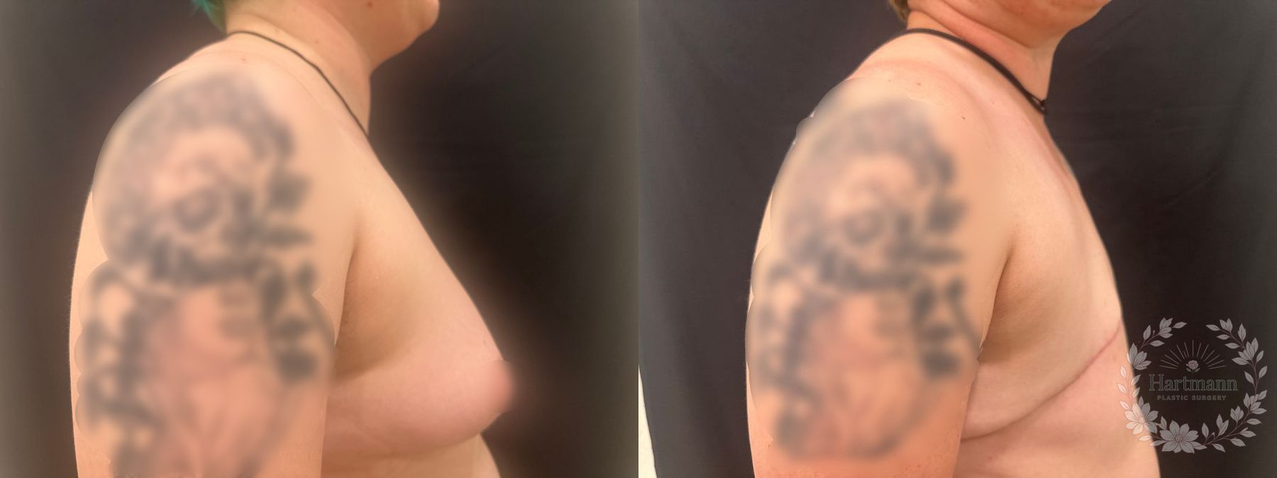Before and after chest masculinization surgery using a double-incision technique without free nipple grafts by Dr. Emily Hartmann, showing a flat, masculine chest contour. - Angle 3