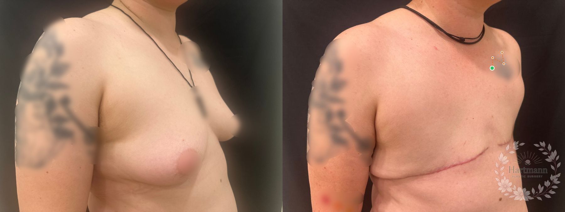 Before and after chest masculinization surgery using a double-incision technique without free nipple grafts by Dr. Emily Hartmann, showing a flat, masculine chest contour. - Angle 2