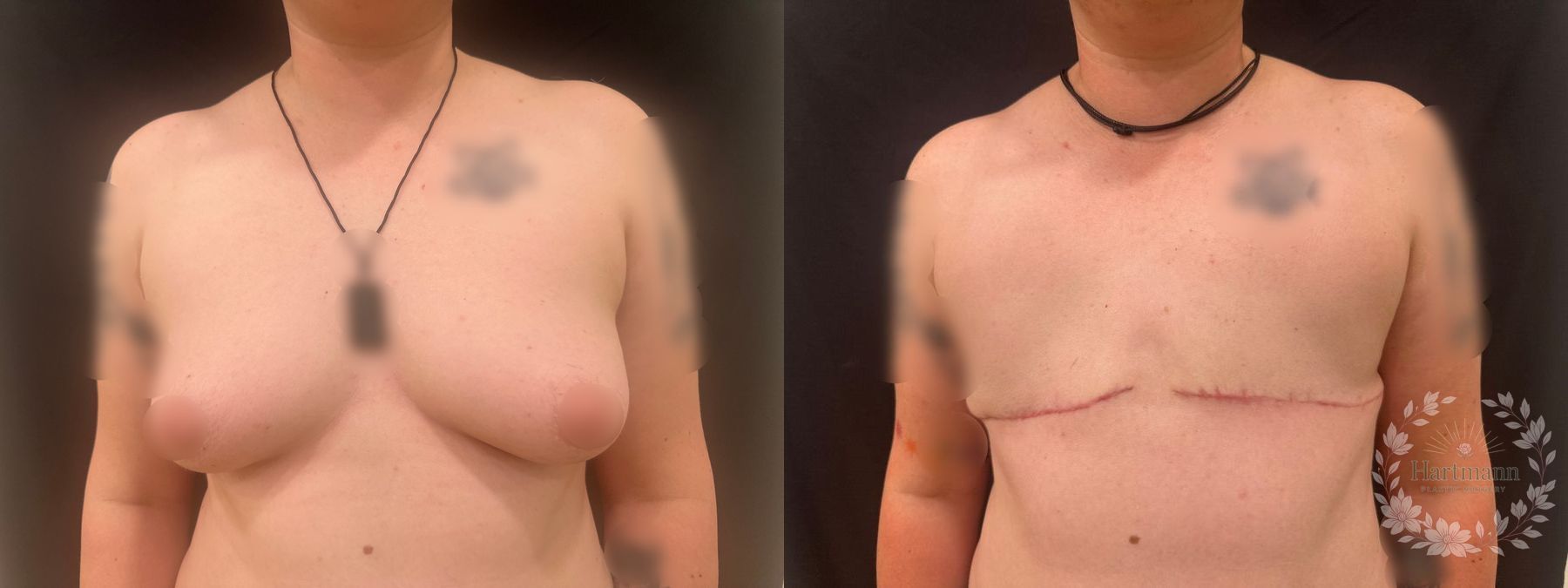 Before and after chest masculinization surgery using a double-incision technique without free nipple grafts by Dr. Emily Hartmann, showing a flat, masculine chest contour.