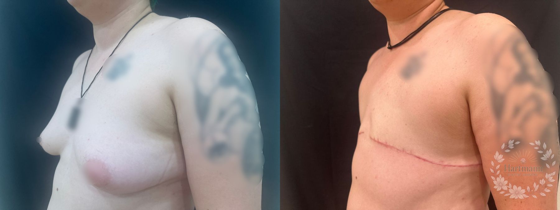 Before and after chest masculinization surgery using a double-incision technique without free nipple grafts by Dr. Emily Hartmann, showing a flat, masculine chest contour. - Angle 4