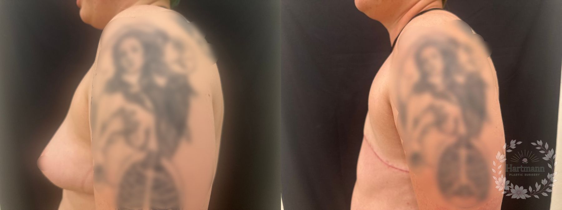 Before and after chest masculinization surgery using a double-incision technique without free nipple grafts by Dr. Emily Hartmann, showing a flat, masculine chest contour. - Angle 5