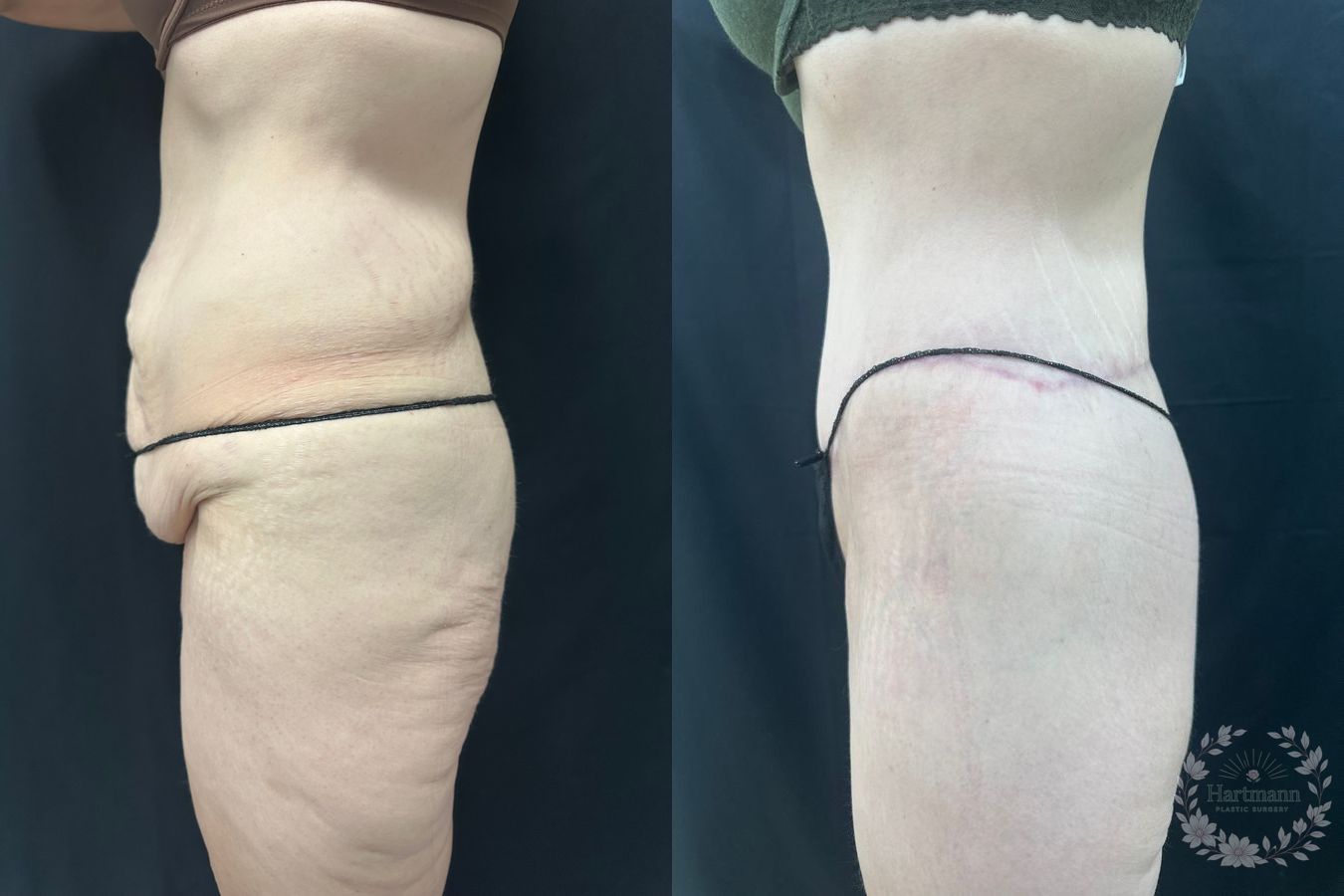 Before and after lower body lift surgery by Dr. Emily Hartmann showing circumferential body contouring after massive weight loss. - Angle 2