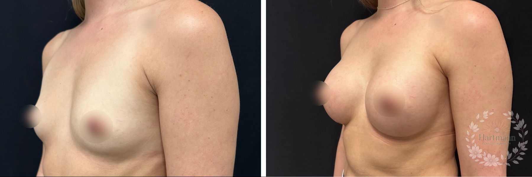 Before and after natural breast augmentation with lift performed by Dr. Emily Hartmann in Chico, California, demonstrating restored breast position and natural-looking fullness. - Angle 2