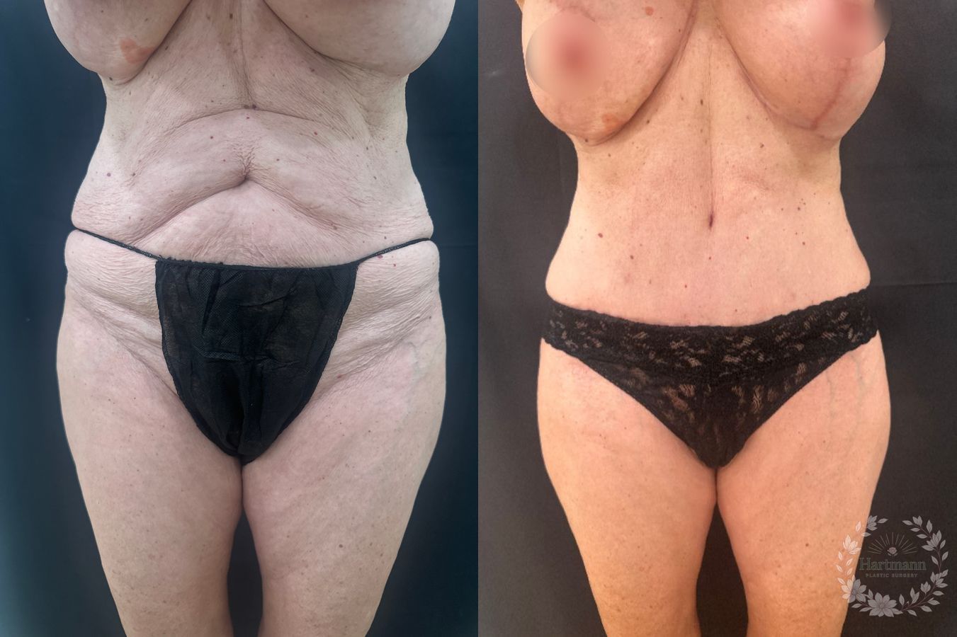 Before and after drainless tummy tuck by Dr. Emily Hartmann in Chico, California, showing a flatter abdomen, improved waistline, and natural body contour.