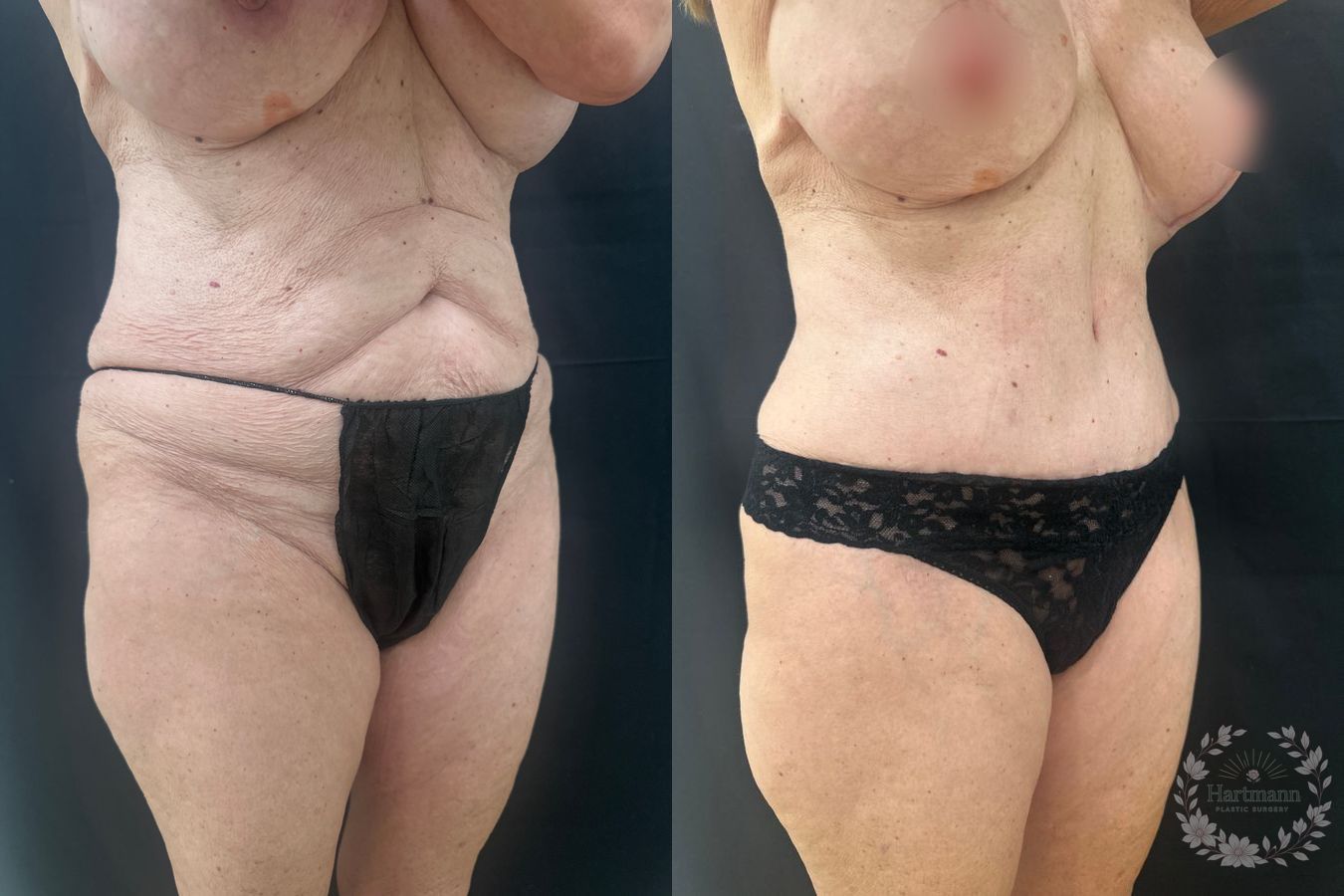 Before and after drainless tummy tuck by Dr. Emily Hartmann in Chico, California, showing a flatter abdomen, improved waistline, and natural body contour. - Angle 3