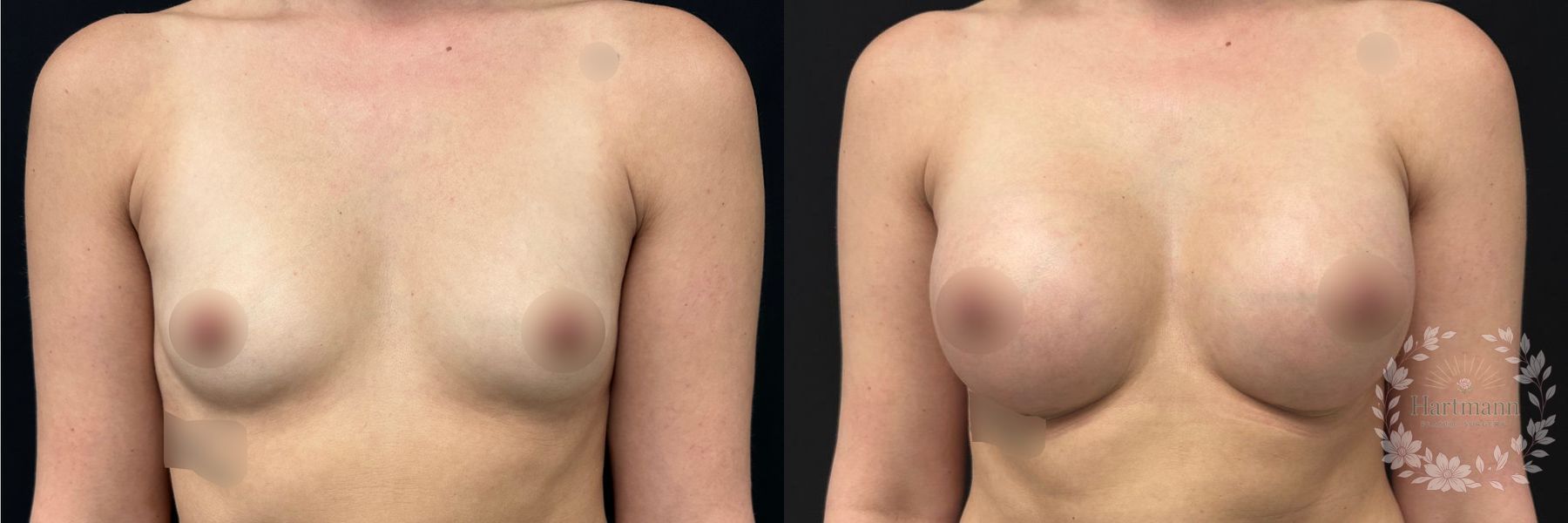 Before and after natural breast augmentation with lift performed by Dr. Emily Hartmann in Chico, California, demonstrating restored breast position and natural-looking fullness.