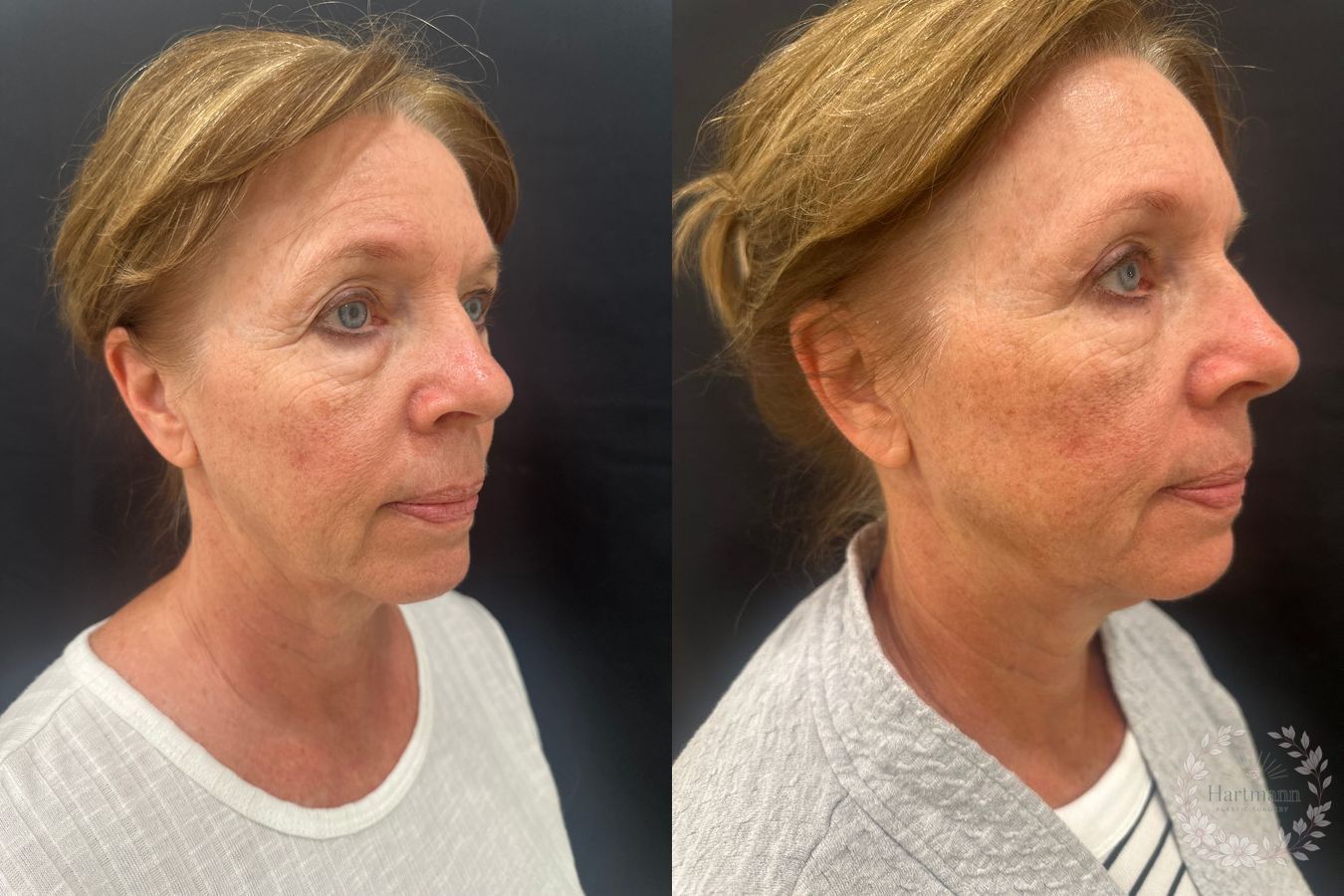 Before and after labiaplasty surgery performed by Dr. Emily Hartmann demonstrating natural-looking reduction of excess labial tissue while preserving normal anatomy. - Angle 3