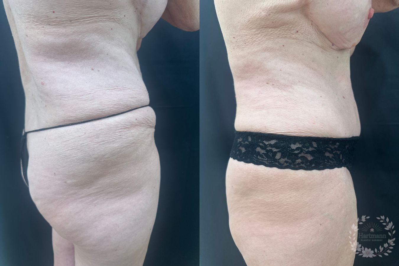 Before and after drainless tummy tuck by Dr. Emily Hartmann in Chico, California, showing a flatter abdomen, improved waistline, and natural body contour. - Angle 2