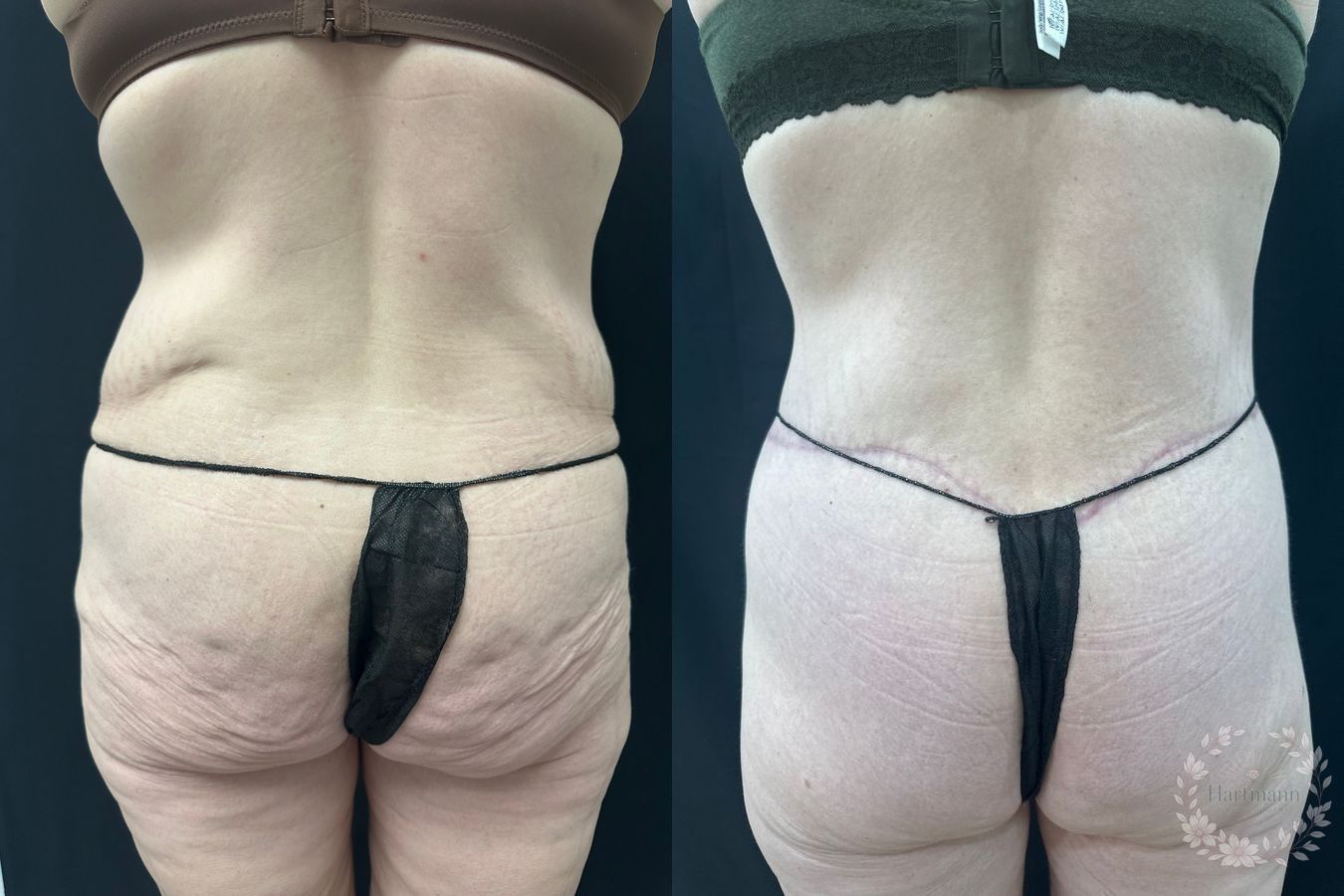 Before and after lower body lift surgery by Dr. Emily Hartmann showing circumferential body contouring after massive weight loss. - Angle 3