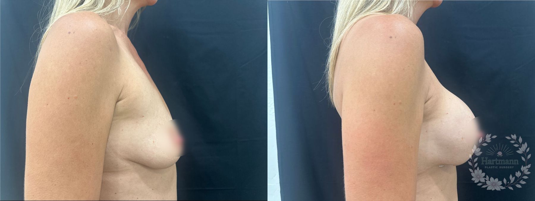 Before and after natural breast augmentation using Motiva Preservé implants by Dr. Emily Hartmann. - Angle 4