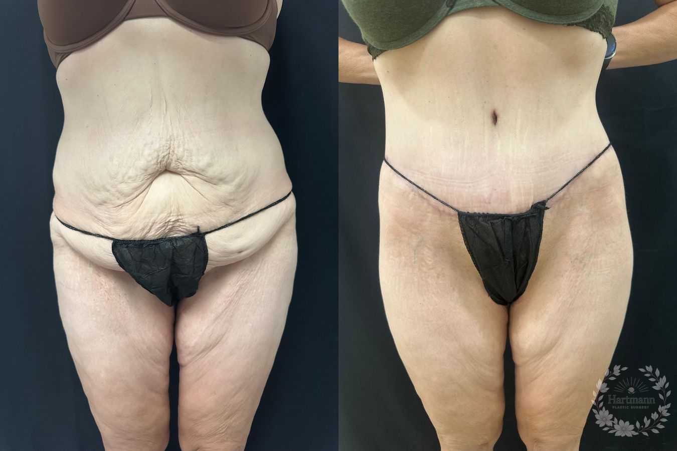 Before and after lower body lift surgery by Dr. Emily Hartmann showing circumferential body contouring after massive weight loss.